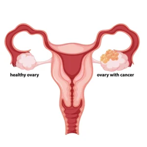 Ovarian Cancer and Its Scope in Homeopathy