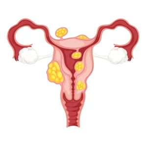 Uterine Fibroids
