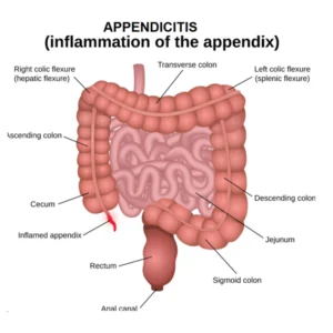 Appendicitis
