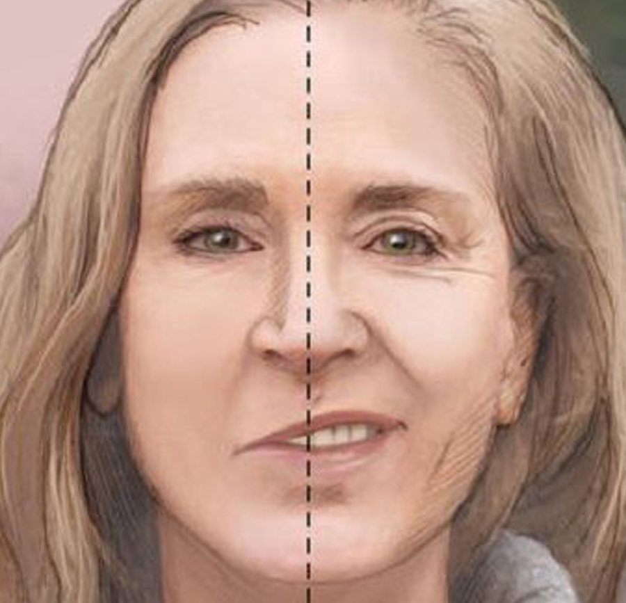 Bell’s Palsy