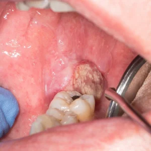 Oral Cancer