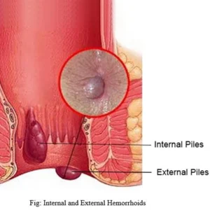 Piles, Haemorrhoids and Fissure