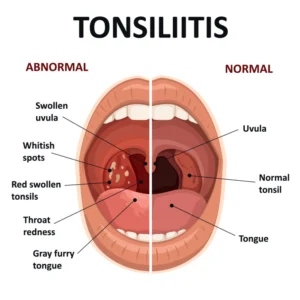Tonsillitis