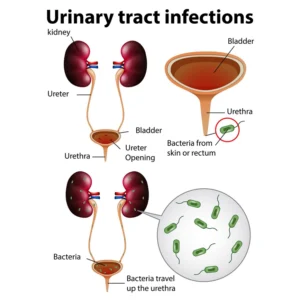 Urinary Tract Infections (Cystitis)