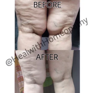 Varicose Veins