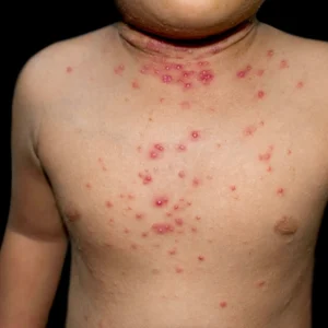 Molluscum Contagiosum