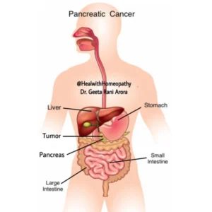 Pancreatic Cancer