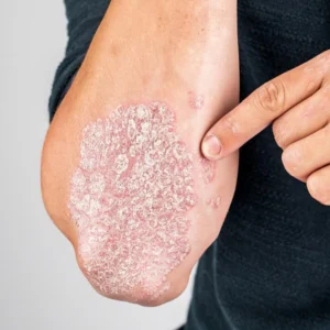 Psoriasis