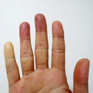 Raynaud’s Phenomenon