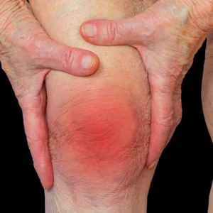 Rheumatoid Arthritis