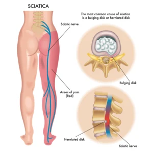 Sciatica