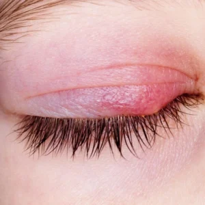 Stye
