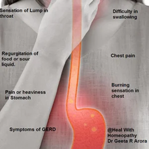 GERD – Gastro Oesophageal Reflux Disorder