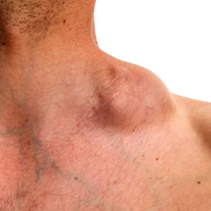 Non-Hodgkin lymphoma