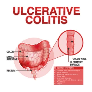 Ulcerative Colitis